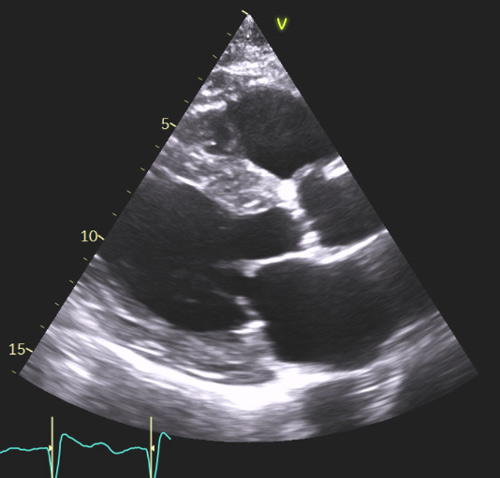 Figure 1 : Aspects morphologiques échocardiographiques typiques d’amylose cardiaque
