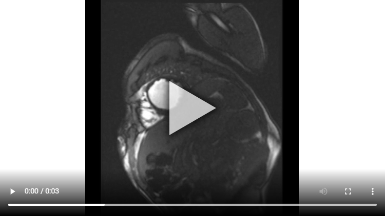 Figure 2A : Séquence de perfusion premier-passage au repos - Coupes petit-axe médian