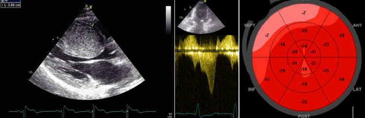 Figure 1 : CMH sarcomérique en échocardiographie