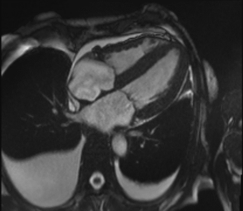 5b : Patient avec amylose cardiaque AL : hypertrophie biventriculaire, hypertrophie du SIA, dilatation bi atriale et épanchements péricardique et pleuraux