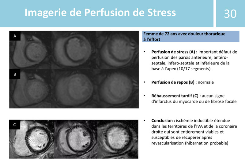 Imagerie de Perfusion de Stress - Femme de 72 ans avec douleur thoracique à l'effort