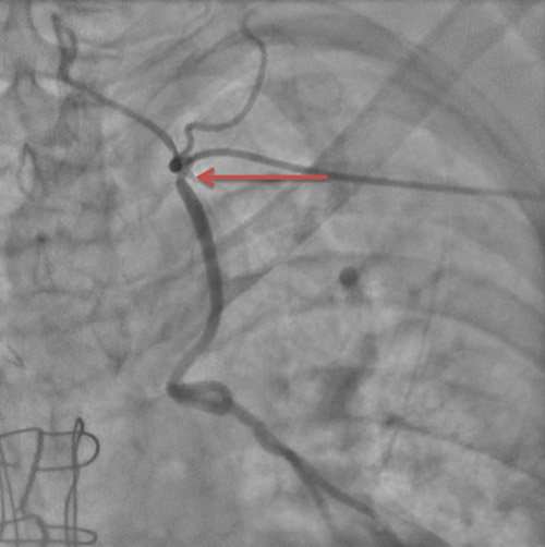 Images 5 : sténose intermédiaire de l’ostium de la mammaire interne gauche