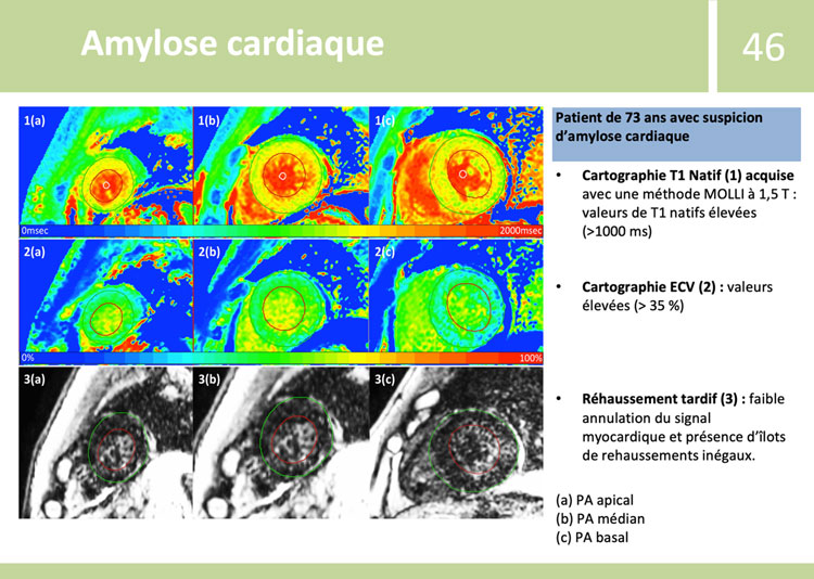 Fiches de synthèse de l’ESC - Amylose cardiaque - exemple 2