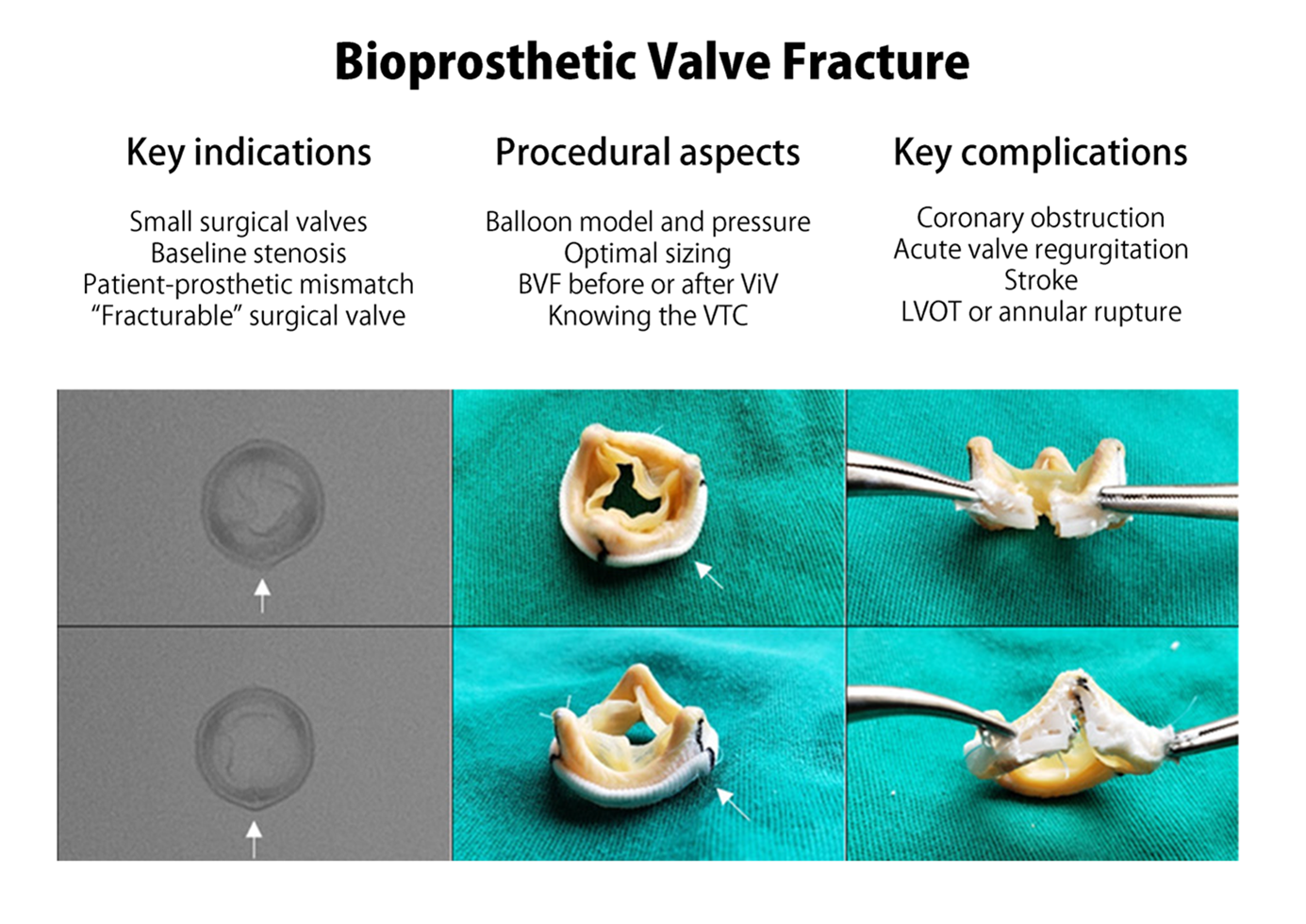 Figure 1. Fracture bioprothèse TAVI : indications clés aspects procéduraux principales complications