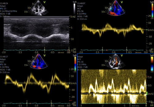 Fig 3 HVG > 12 mm mais aussi VD en sous-costal