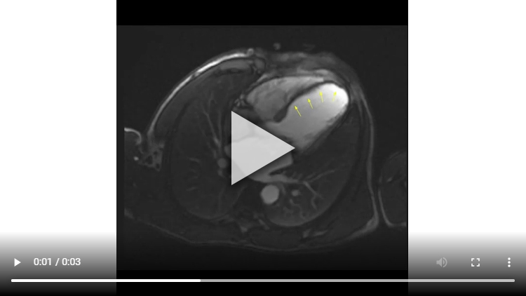 Figure 2C : Séquence de perfusion premier-passage au repos - Coupes 4-cavités
