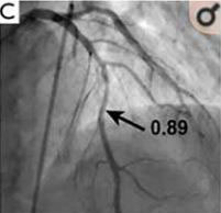 Scanner coronaire de perfusion et FFR-CT - Figure 3c