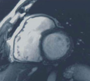 Diastole