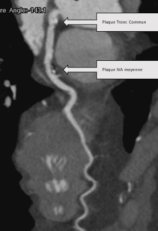 Figure 1 : Exemple d'un coroscanner réalisé en dépistage chez un patient de 50 ans tabagique à 30 PA asymptomatique