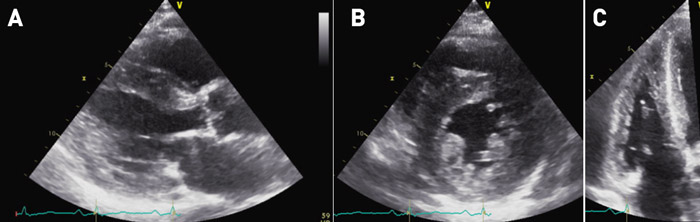 Figure 1 : Hypertrophie des ventricules en échocardiographie