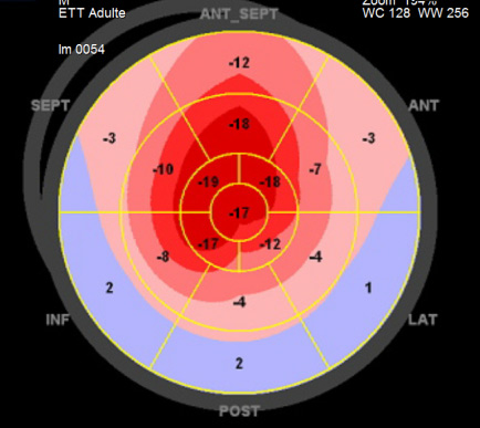 Figure 3 : Aspect caractéristique du strain longitudinal VG “en cocarde” évocateur de cardiopathie infiltrative et donc d’amylose en premier lieu