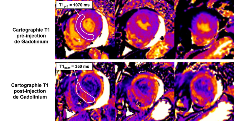 Figure 6 : Cartographie T1 pré et post injection de gadolinium  Coupes petit-axe basal, médian et apical 