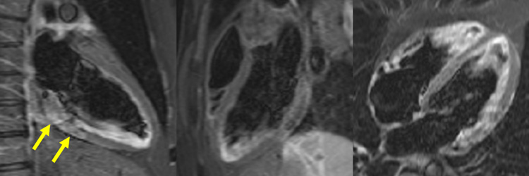 Figure 6b : Séquence T2 STIR - Coupes long-axe