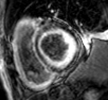 Figure 6 : Rehaussements tardifs touchant typiquement les deux ventricules et débutant en sous-endocardiques avec un aspect caractéristique « en rails » du septum inter-ventriculaire en cas d’amylose cardiaque