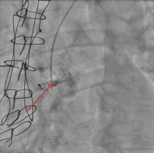 Image 3 : occlusion chronique de la coronaire droite ostiale