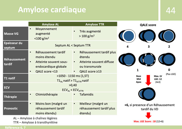 Fiches de synthèse de l’ESC - Amylose cardiaque - Amylose AL et TTR