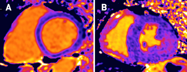 Figure 2 : T1 mapping en cas de maladie de Fabry