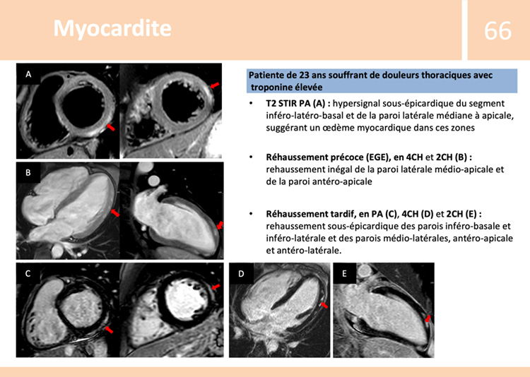 Fiche de synthèse : IRM cardiaque - 2