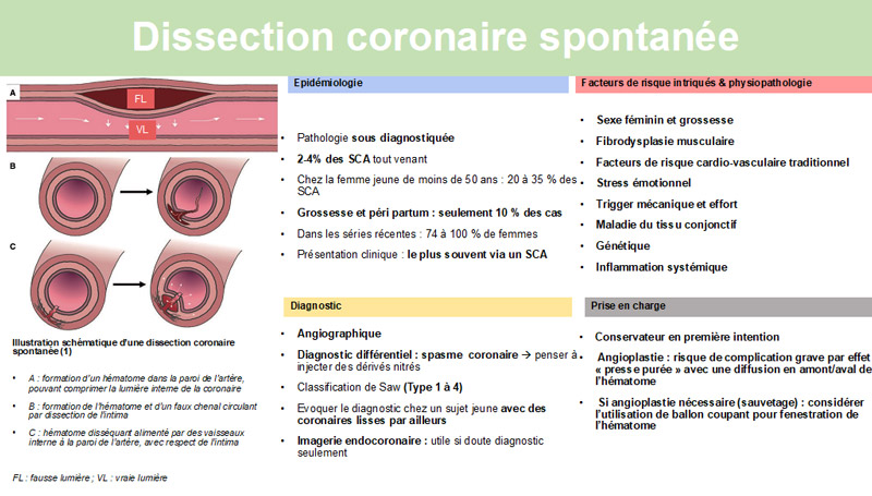 Fiche de synthèse - Dissection coronaire spontanée