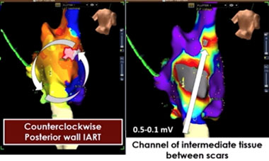 Rôle de l’imagerie dans l’ablation des cardiopathies congénitales