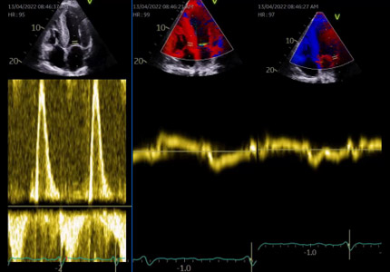 Fig 4 Amylose TTR sauvage, 75 ans: en FA avec un DTI très altéré    (s’ et e’ < 6 cm/s)  Strain atrial < 20% mais non totalement effondré dans ce cas