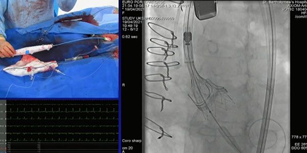 TAVI valve in valve : état des lieux à EuroPCR