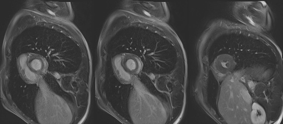 imagerie-cardiaque-cas-clinique-en-direct-de-Lariboisiere-sequence-de-rehaussement-tartdif-coupe-petit-axe