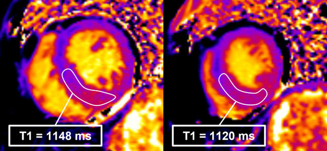 Figure 3 : Séquence T1-mapping pré-injection, coupes petit-axe