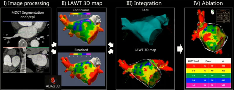 Ablation de fibrillation atriale guidée par l’ablation index en fonction de l’épaisseur de la paroi atriale