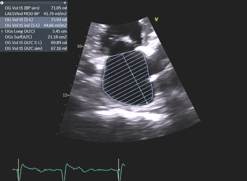 Exemple de pressions de remplissages élevées chez un patient avec amylose cardiaque : E/A >2, E/E’ moyen = 13, volume biplan indexé de l’OG > 34 ml/m² SC, Vmax de l’IT proche de 2.8 m/s