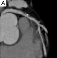 Scanner coronaire de perfusion et FFR-CT - Figure 3a