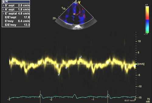 Figure 2 : Pressions de remplissage VG élevées souvent élevées en cas d’amylose cardiaque évolutive. 