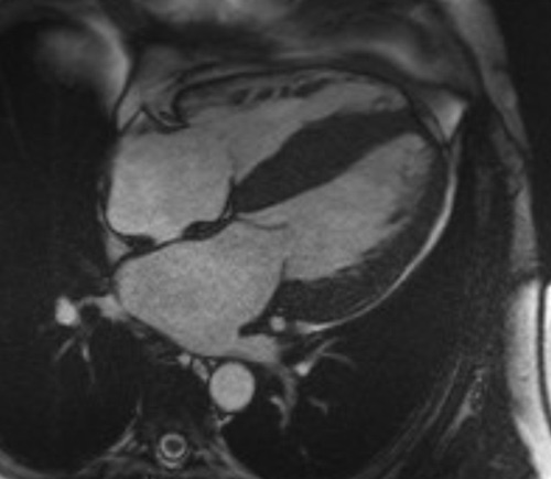 5a : Patient avec amylose cardiaque TTR : hypertrophie VG diffuse, hypertrophie du SIA, dilatation biatriale 
