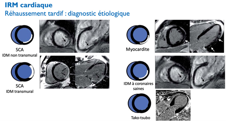 Synthèse : faire le diagnostic étiologique de Myocardite, Infarctus ou Syndrome de Tako-tsubo selon la topographie du réhaussement tardif.