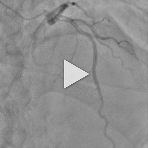 Figure 4 : Suivi du patient - coronarographie de contrôle à 3 mois