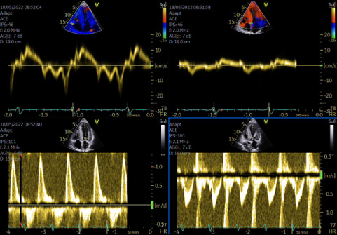 Fig 1 Amylose TTR héréditaire . 64 ans 