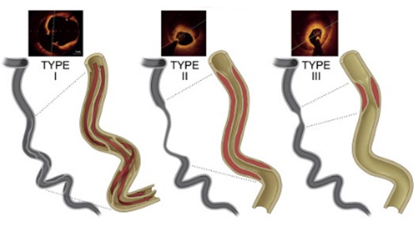 Figure 3 : Classification des dissections coronaires spontanées illustrées (1,2)
