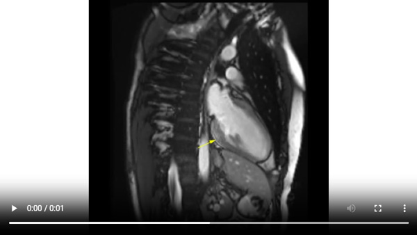 Visualisation rehaussement myocardique systolique - 2 cavités