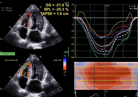 Fig 3 HVG > 12 mm mais aussi VD en sous-costal  Profil diastolique de type trouble de la relaxation, possible dans l’amylose TTR à un stade pas trop sévère , comme ici où le strain VD est preserve > 23%
