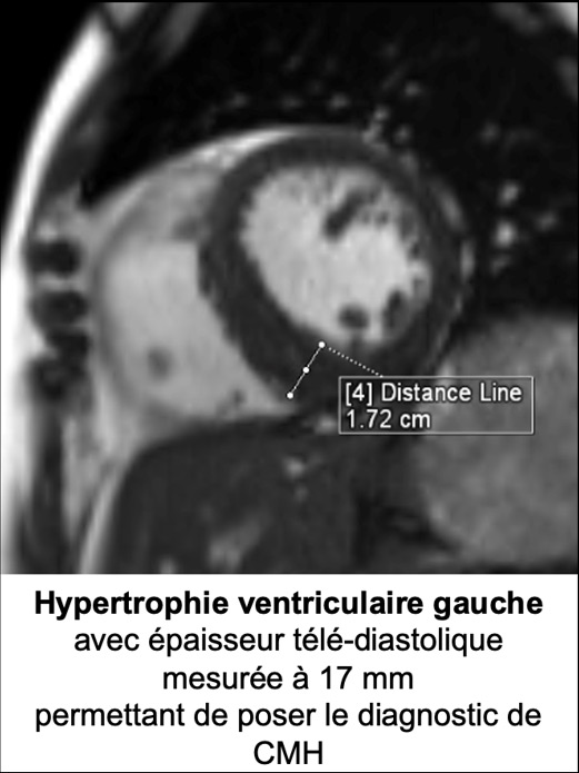 Figure 1 : Séquence Ciné-IRM réalisée après injection de Gadolinium