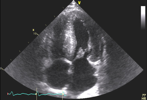 a- HVG concentrique diffuse avec dilatation biatriale               