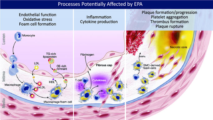 Ath&eacute;roscl&eacute;rose et physiopathologie - EPA