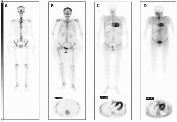 Figure 4 : Différents grade de fixation cardiaque à la scintigraphie osseuse en cas d’amylose cardiaque. D’après Perugini E et al JACC 2005;46:1076-84