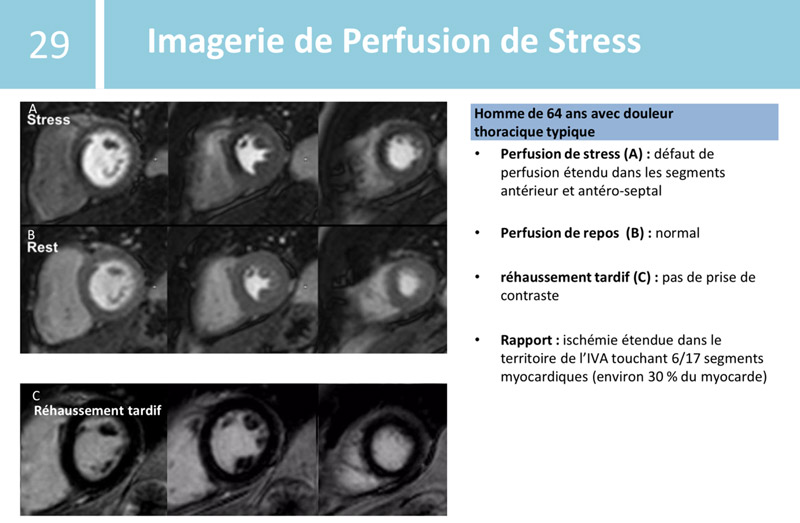 Imagerie de Perfusion de Stress - Homme de 64 ans avec douleur thoracique typique