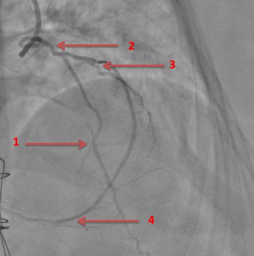 Image 4 :  Flèche 1 : anastomose mammaire interne gauche – IVA Flèche 2 : Mammaire interne droite  « branchée en Y » sur mammaire interne gauche Flèche 3 : anastomose mammaire interne droite – Marginale Flèche 4 : anastomose mammaire interne droite - IVP