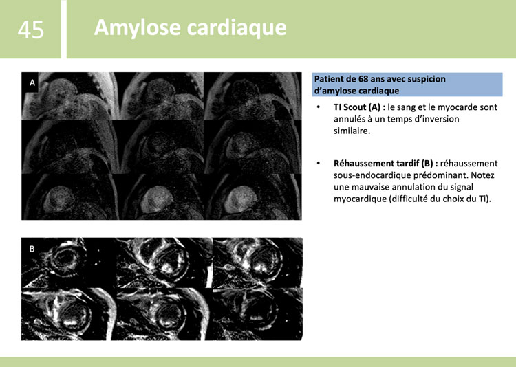 Fiches de synthèse de l’ESC - Amylose cardiaque - exemple 1