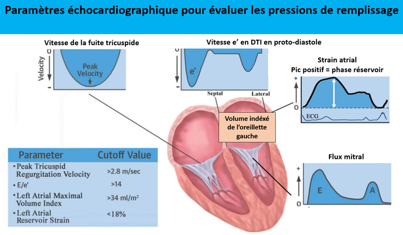 Fig 2 Paramètres échocardiographique pour évaluer les pressions de remplissage