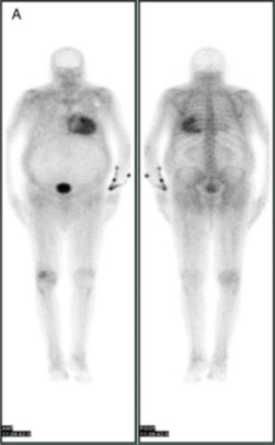 Figure 1: Fixation cardiaque à la scintigraphie DPD