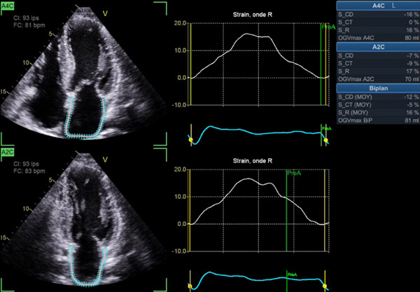 Fig 4 Amylose TTR sauvage, 75 ans: en FA avec un DTI très altéré (s’ et e’ < 6 cm/s) Strain atrial < 20% mais non totalement effondré dans ce cas