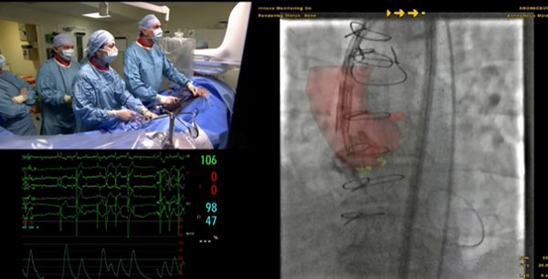 TAVI valve in valve : état des lieux à EuroPCR